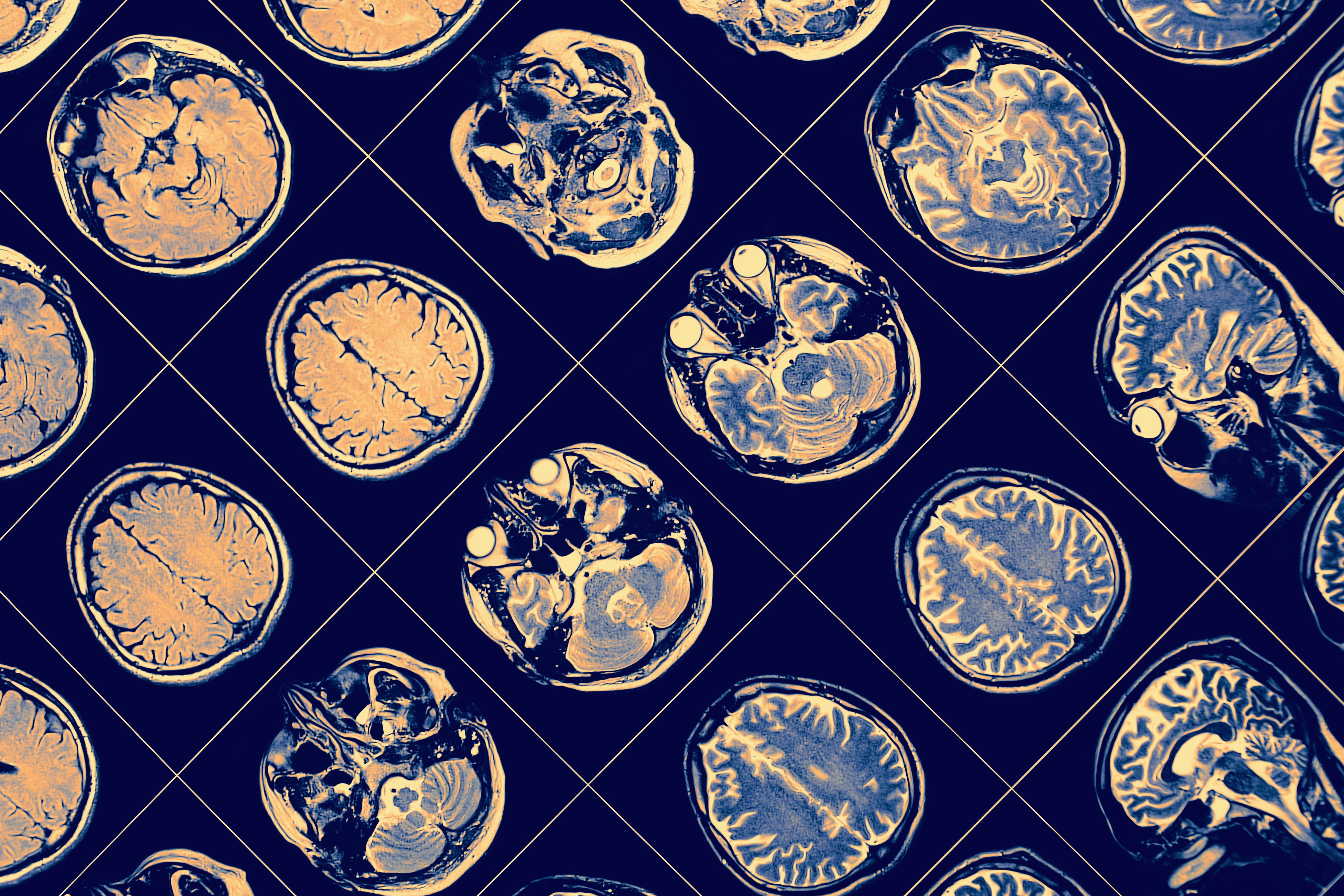 8 hábitos sencillos que reducen el riesgo de Alzheimer y otras formas demencia, según estudios recientes