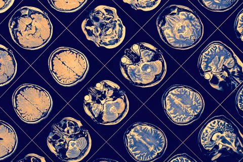 8 hábitos sencillos que reducen el riesgo de Alzheimer y otras formas demencia, según estudios recientes